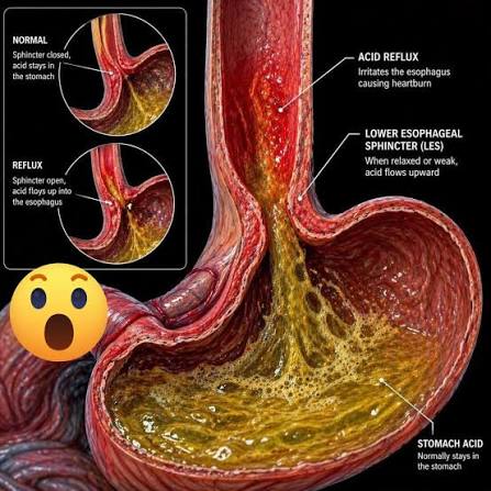 Why 95% of Acid Reflux Sufferers Are Treating the Wrong Problem (And What Actually Works)